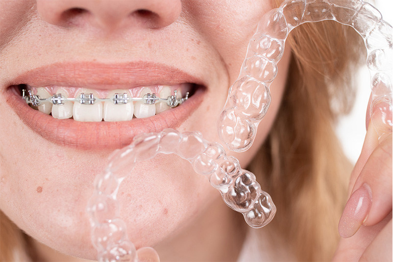 יופי של חיוך - הפתרונות האסתטיים ליישור שיניים בחיפה