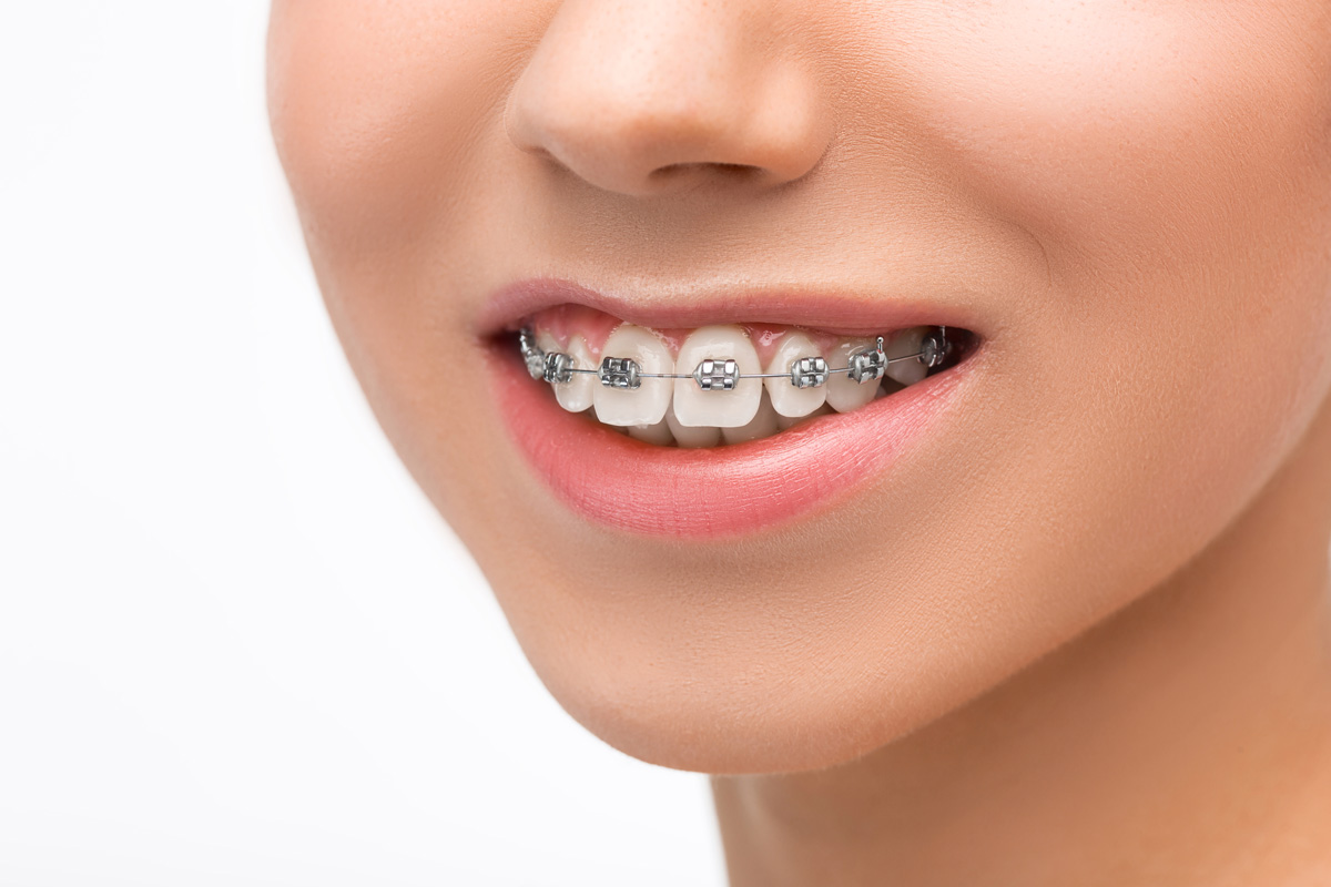 התהליך המלא של יישור שיניים - מה צפוי לכם לאורך הדרך?